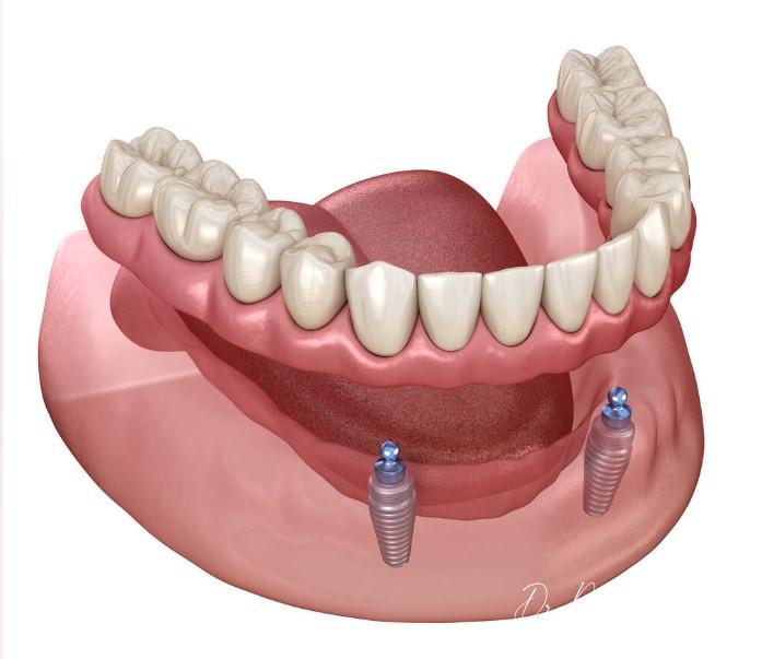 Implant Supported Dentures 1 