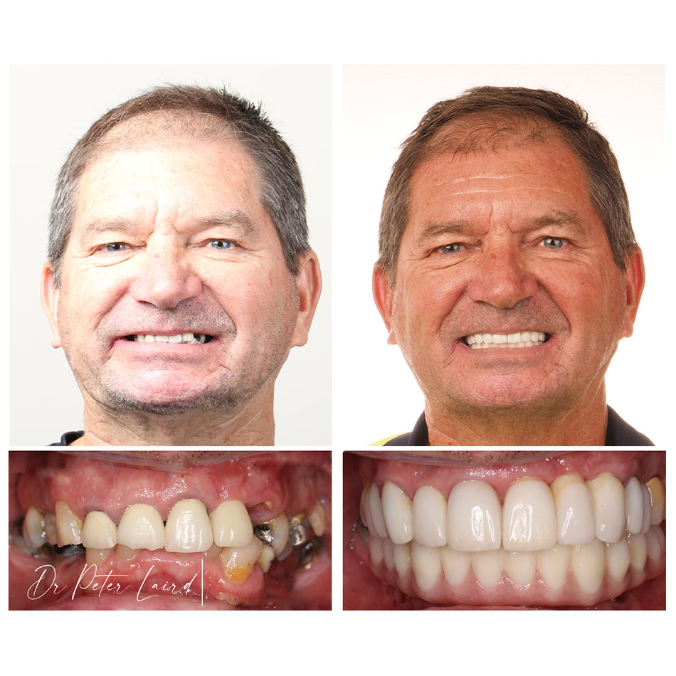 Before and After Dental Photo 1