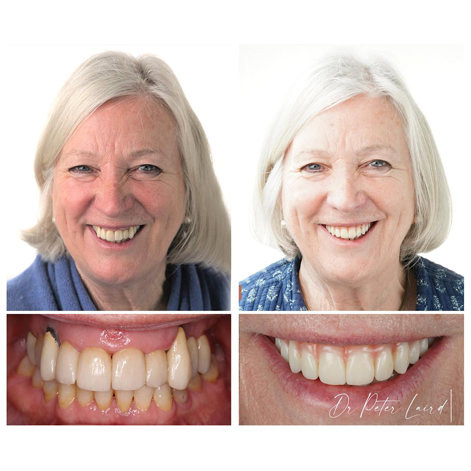 Before and After Dental Photos 2