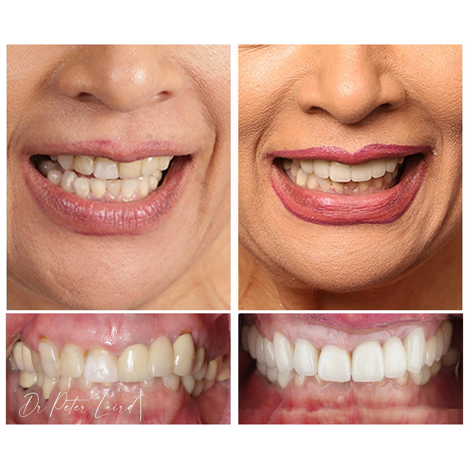 Before and After Dental Photos 5