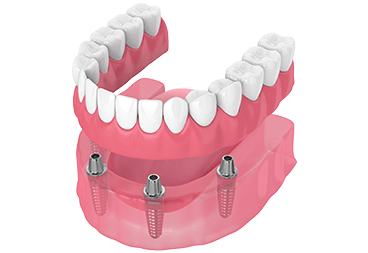 All On X (Full Arch Dental Implants)