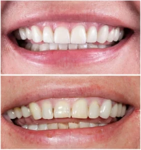 Are Yellow Teeth Stronger Than White Teeth changes Are Yellow Teeth Stronger Than White Teeth changes
