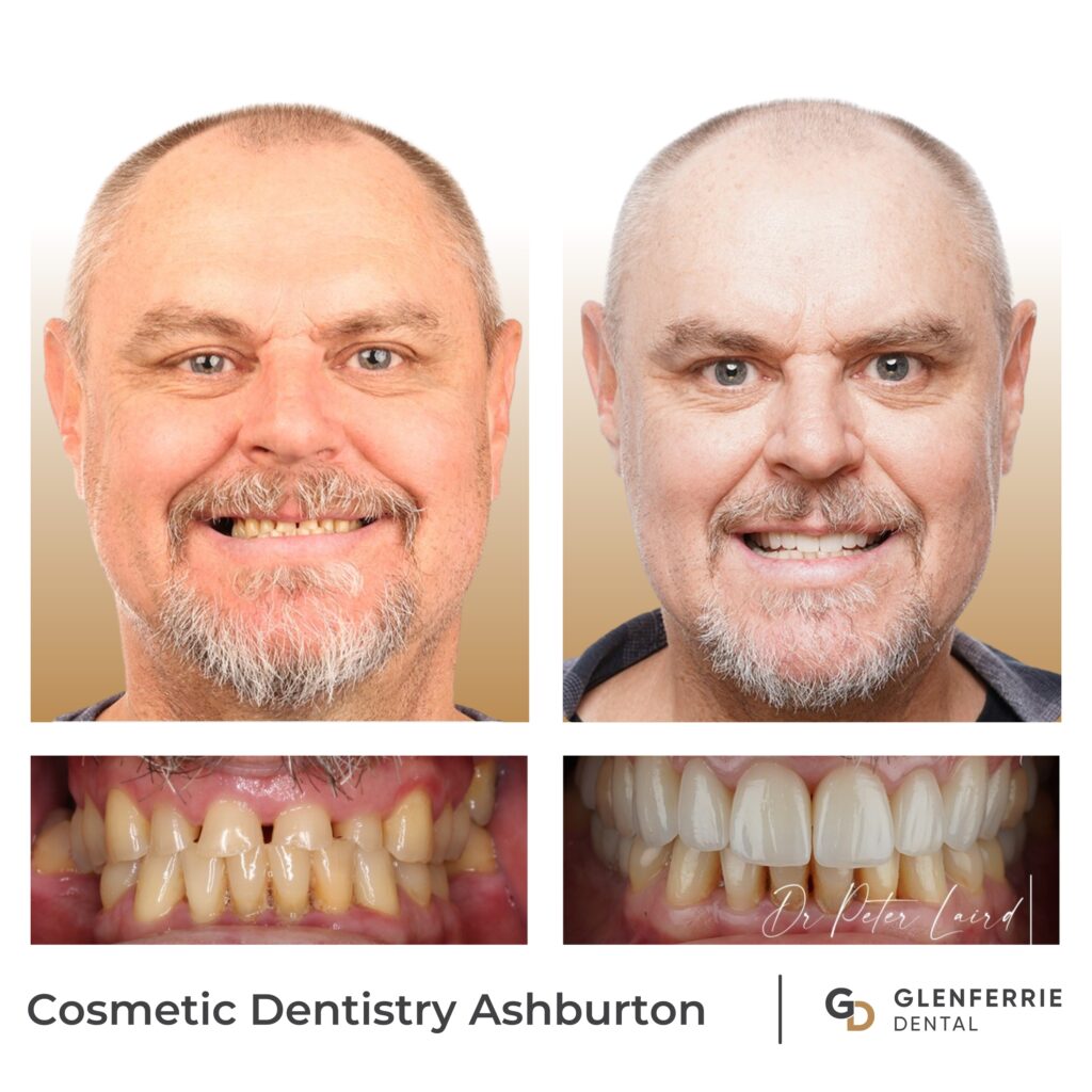 Cosmetic Dentistry Ashburton