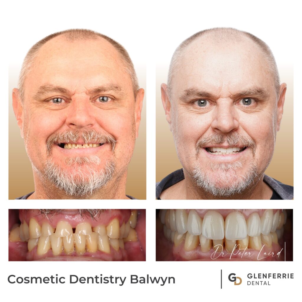 Cosmetic Dentistry Balwyn