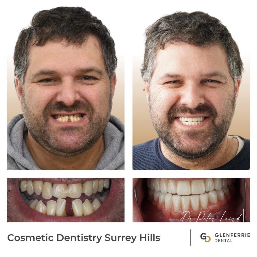 Cosmetic Dentistry Surrey Hills