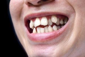Sparse Teeth Crowded Teeth Treatment Options for a Straighter Smile