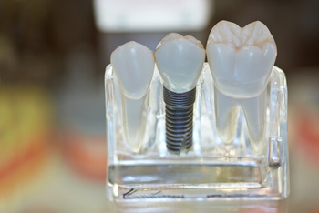 Dental Implant Kuala Lumpur illustration hawthorn