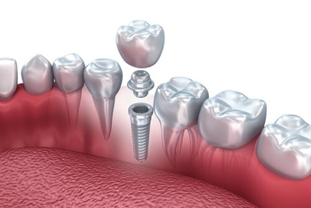Dental Implant Kuala Lumpur post hawthorn