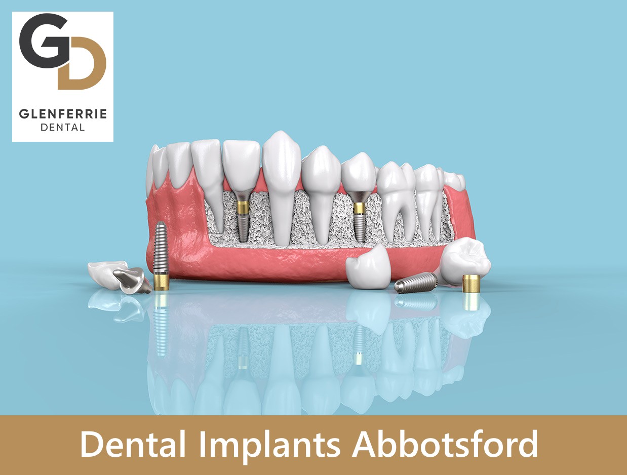 Dental Implants Abbotsford