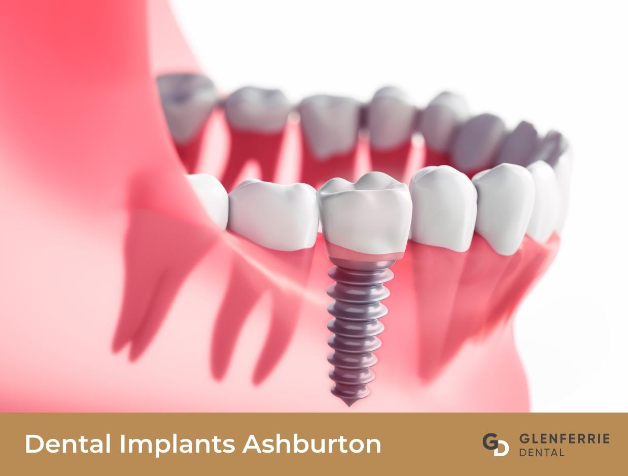 Dental Implants Ashburton