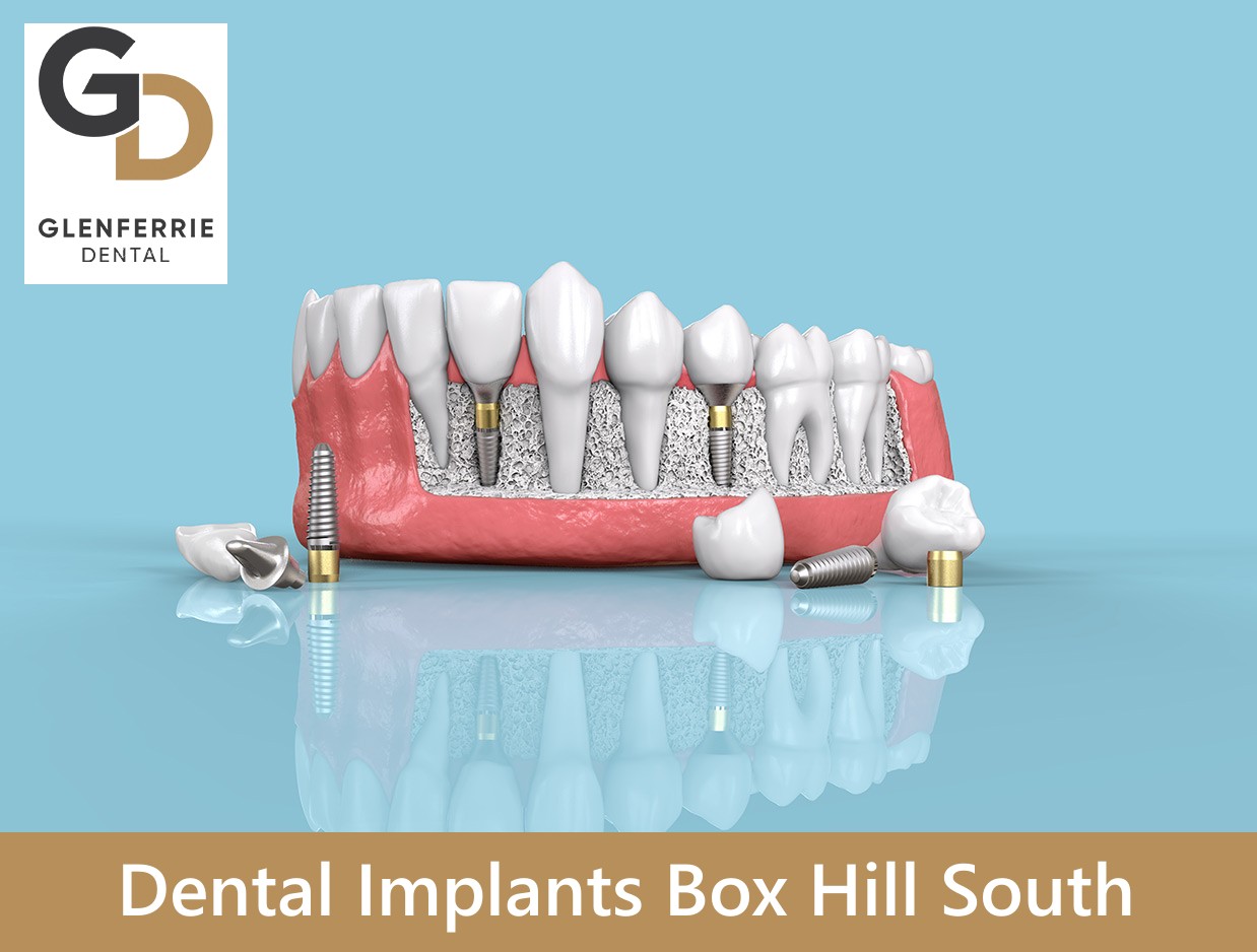 Dental Implants Box Hill South