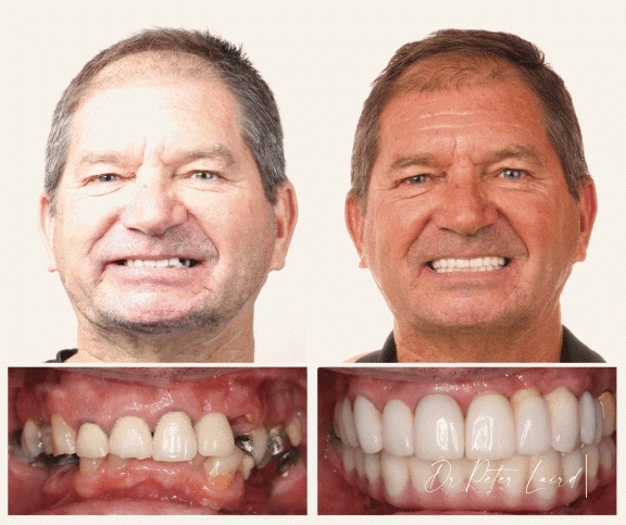 Dental Implants Before and After