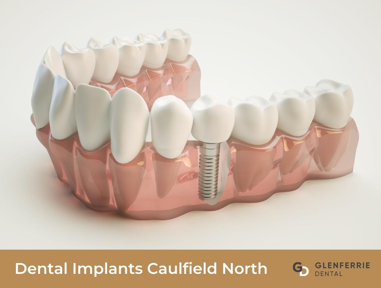 Dental Implants Caulfield North