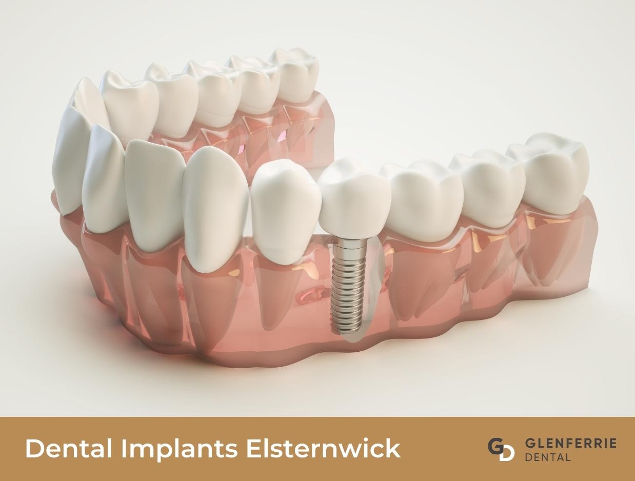 Dental Implants Elsternwick