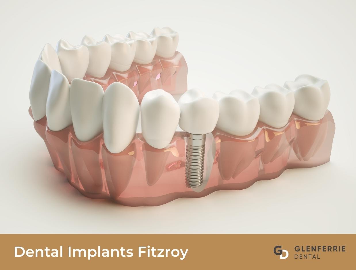 Dental Implants Fitzroy