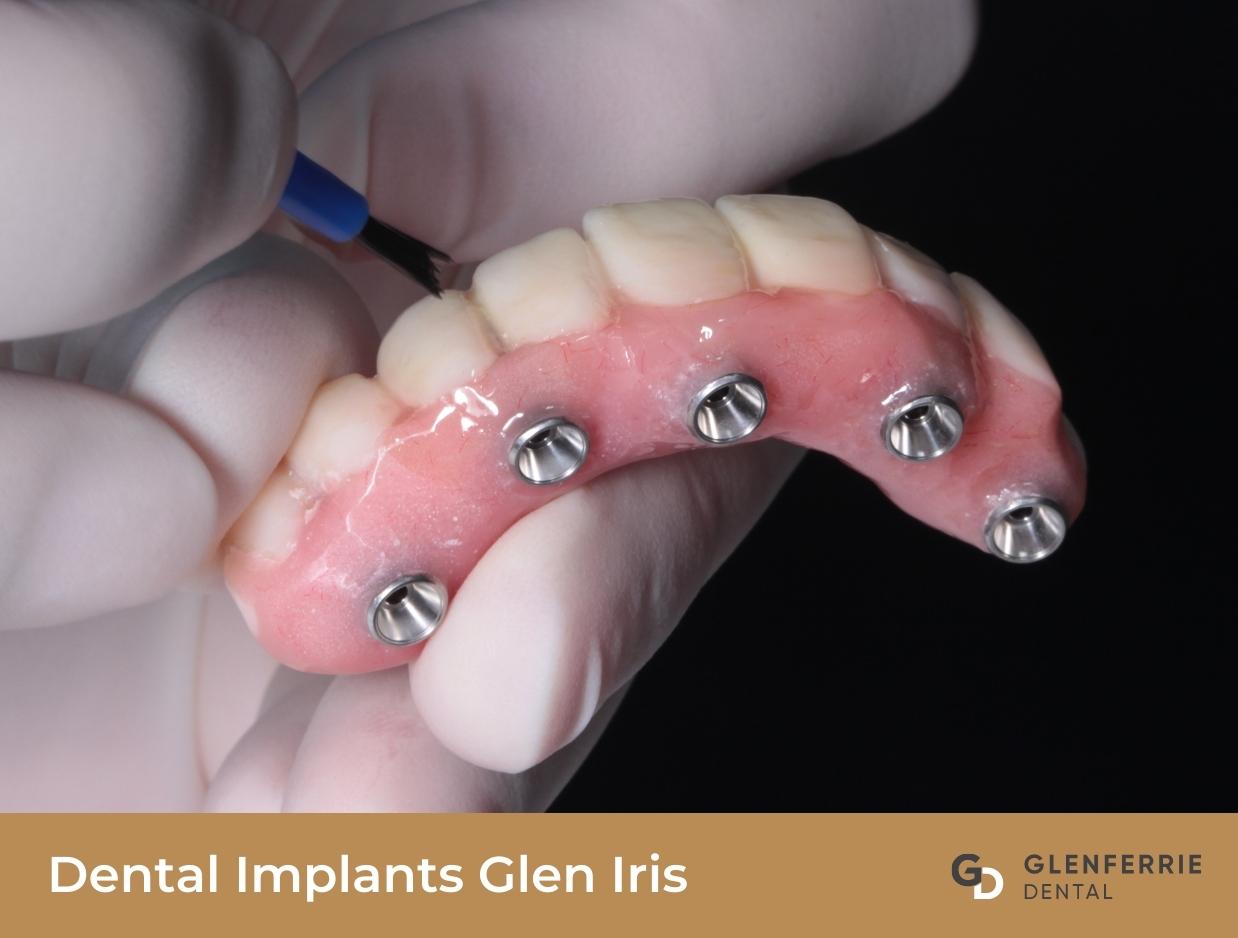 Dental Implants Glen Iris