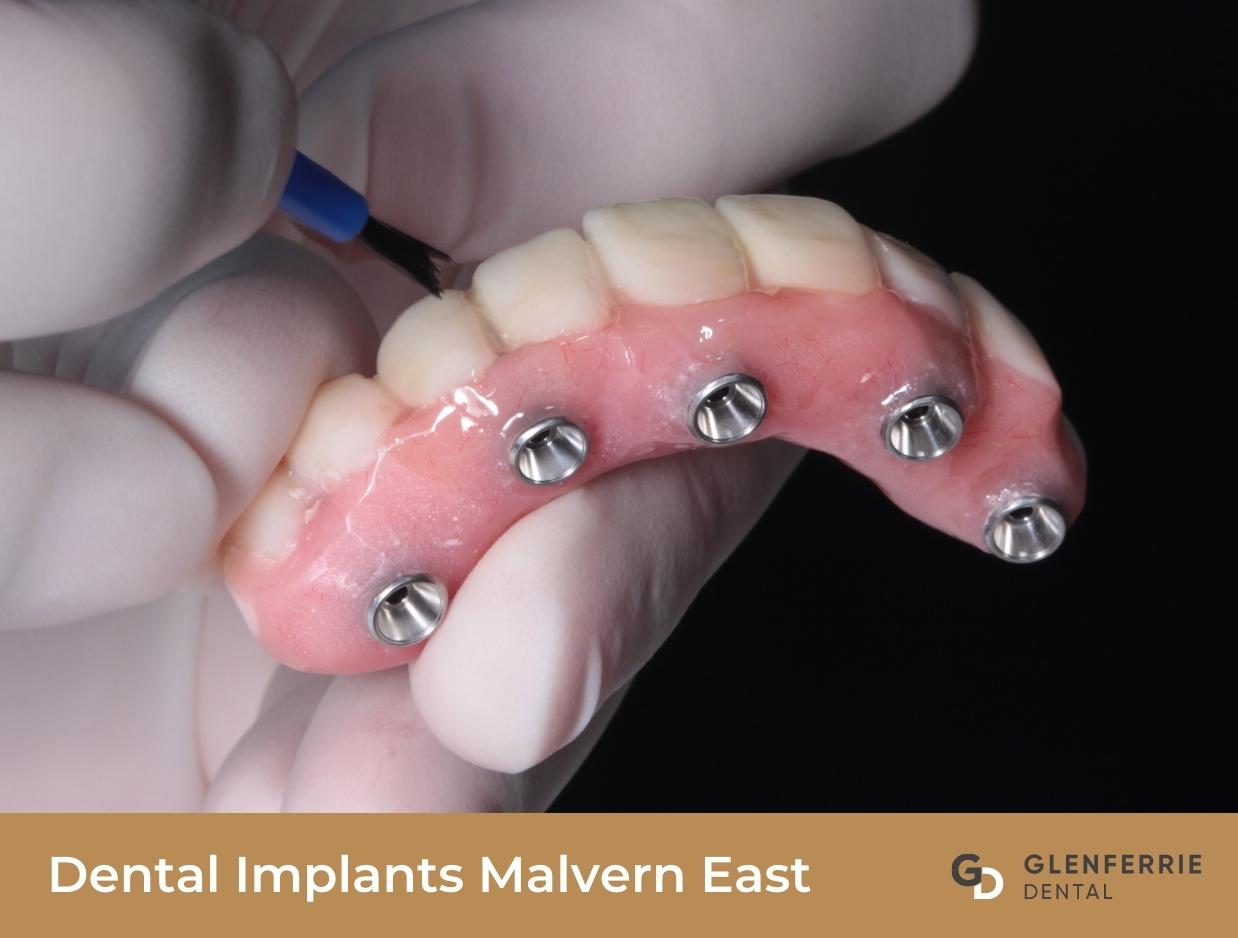 Dental Implants Malvern East