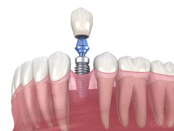 Dental Implants Manila placement hawthorn