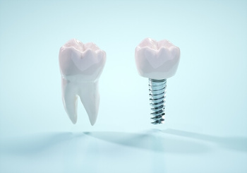 Dental Implants Pattaya missing tooth hawthorn