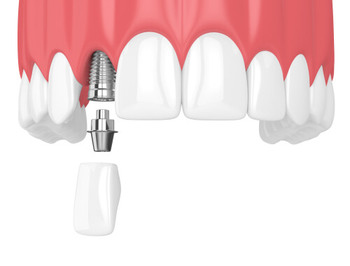 Dental Implants Philippines illustration