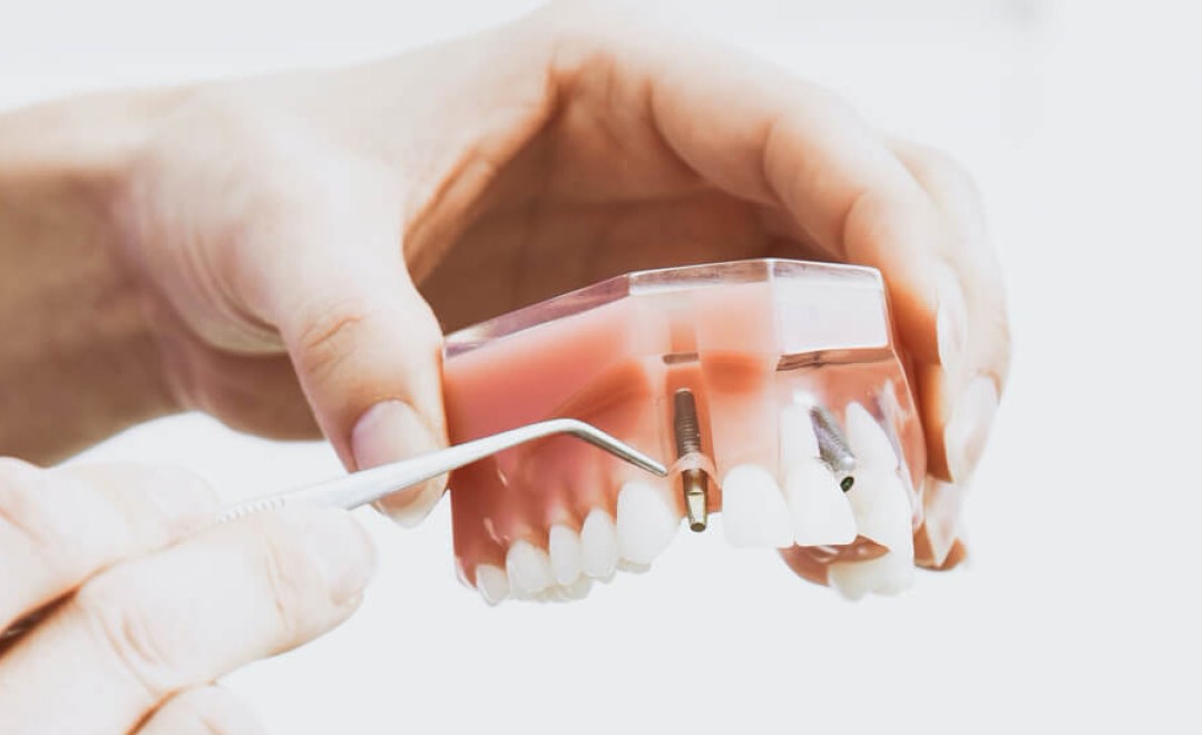 Dental Implants hero Glenferrie dental