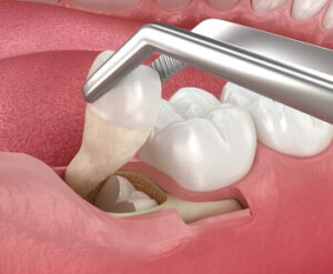 How Soon After Tooth Extraction Can You Have an Implant extraction