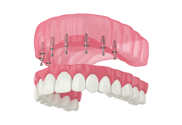 Implant Supported Dentures