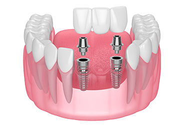 Multiple Teeth Implants (Implant Supported Bridges)