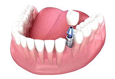 Single Tooth Implants