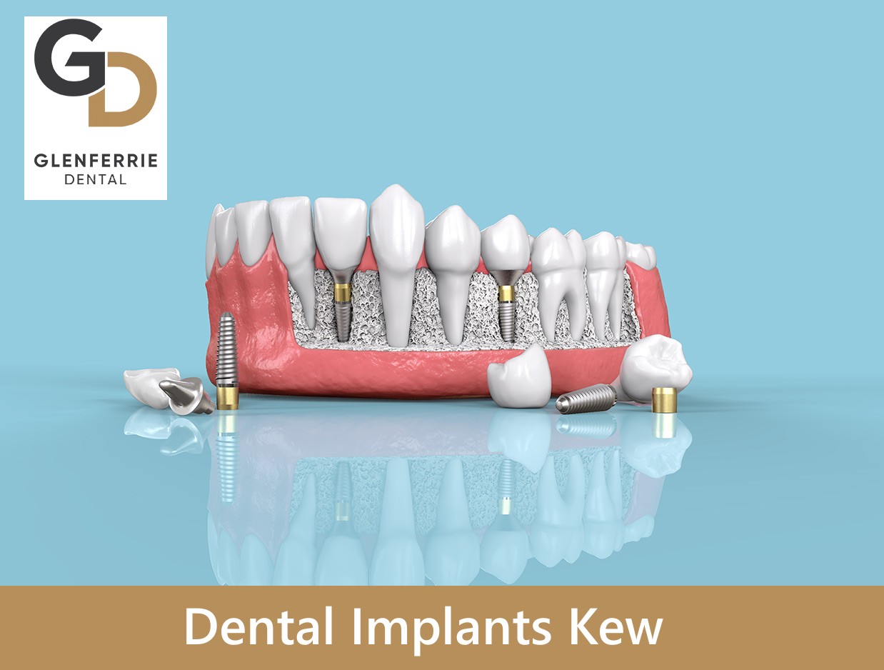 dental implants kew