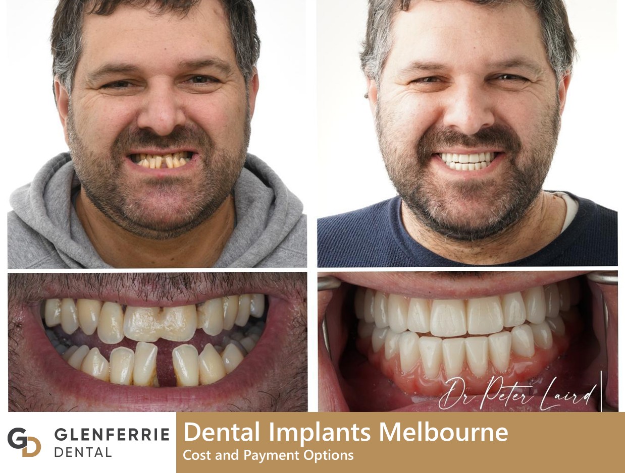 dental implants melbourne cost