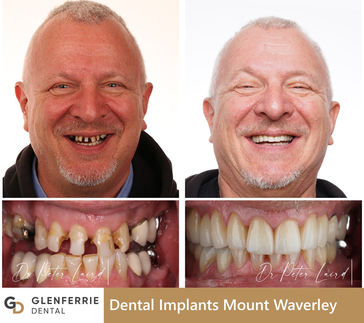 dental implants mount waverley