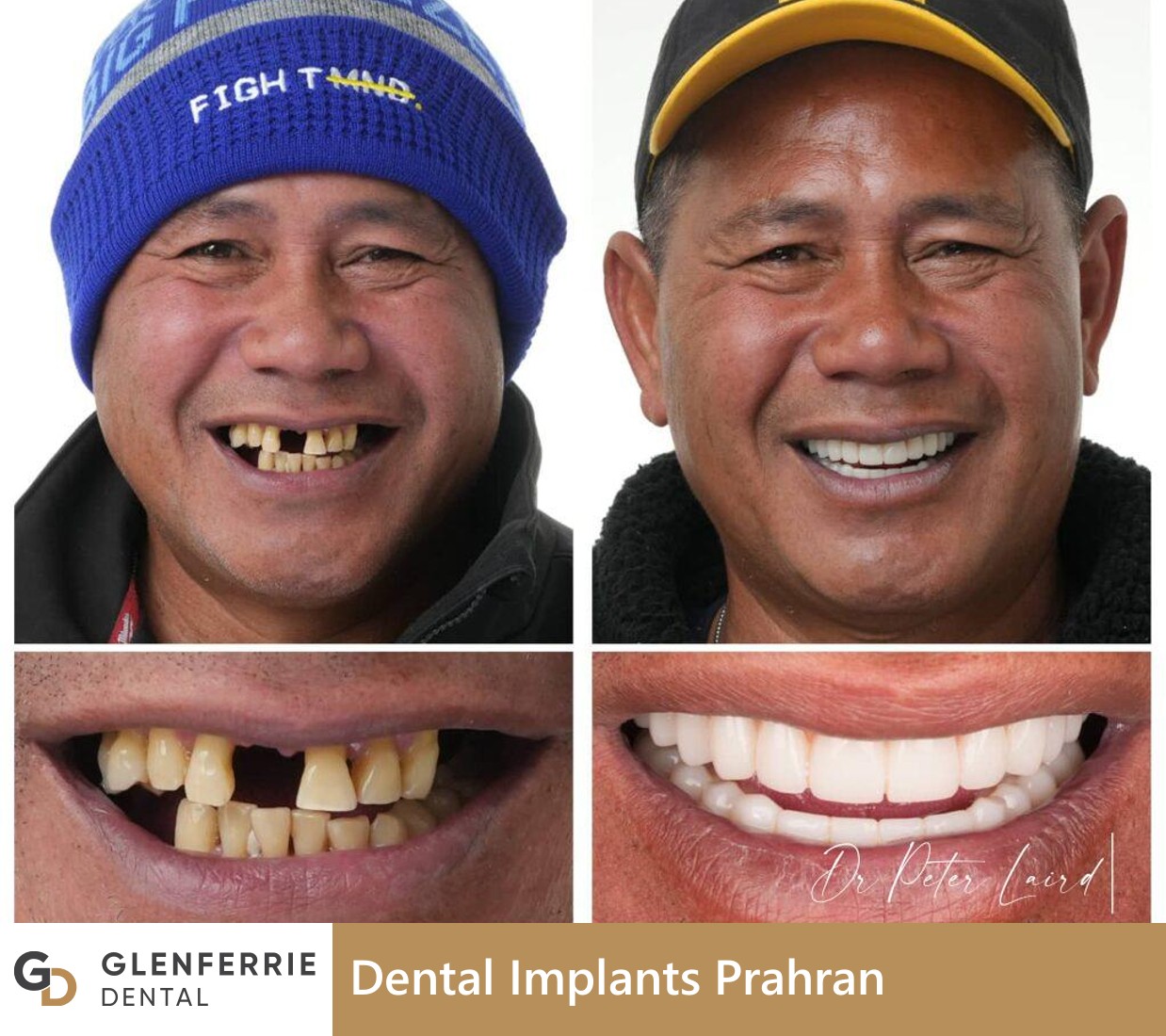 dental implants prahran