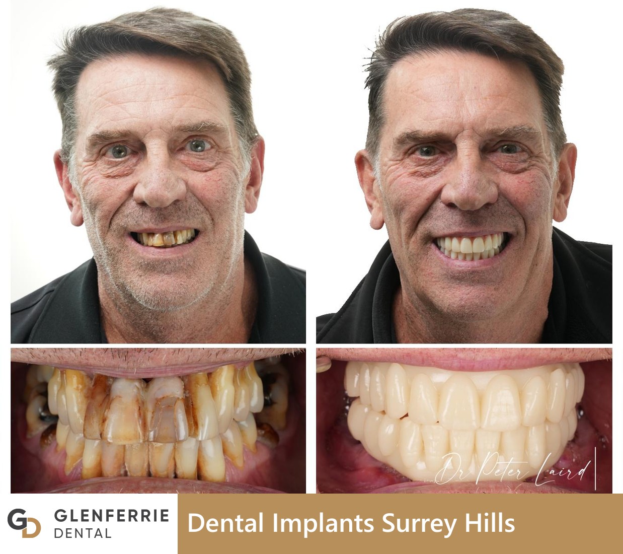 dental implants surrey hills