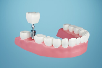 dental implant cost factors
