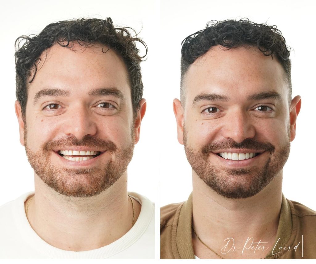 henson adam - before and after