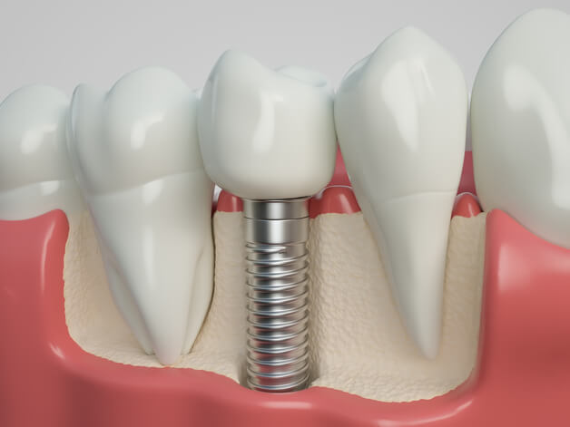 out of the country dental implants hawthorn
