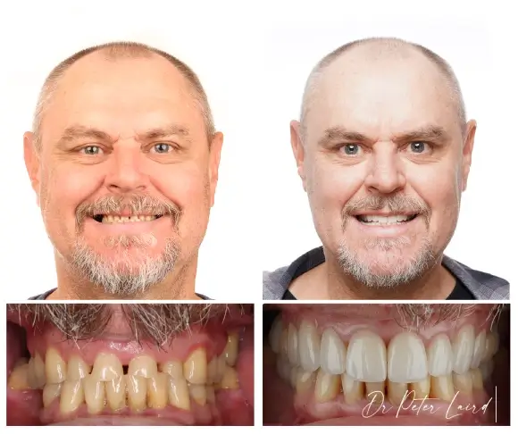smile makeover melbourne case 3