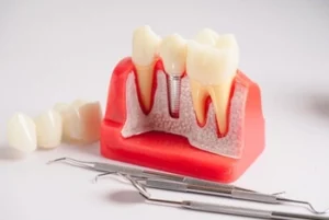 symptoms of loose dental implant crown procedure symptoms of loose dental implant crown procedure