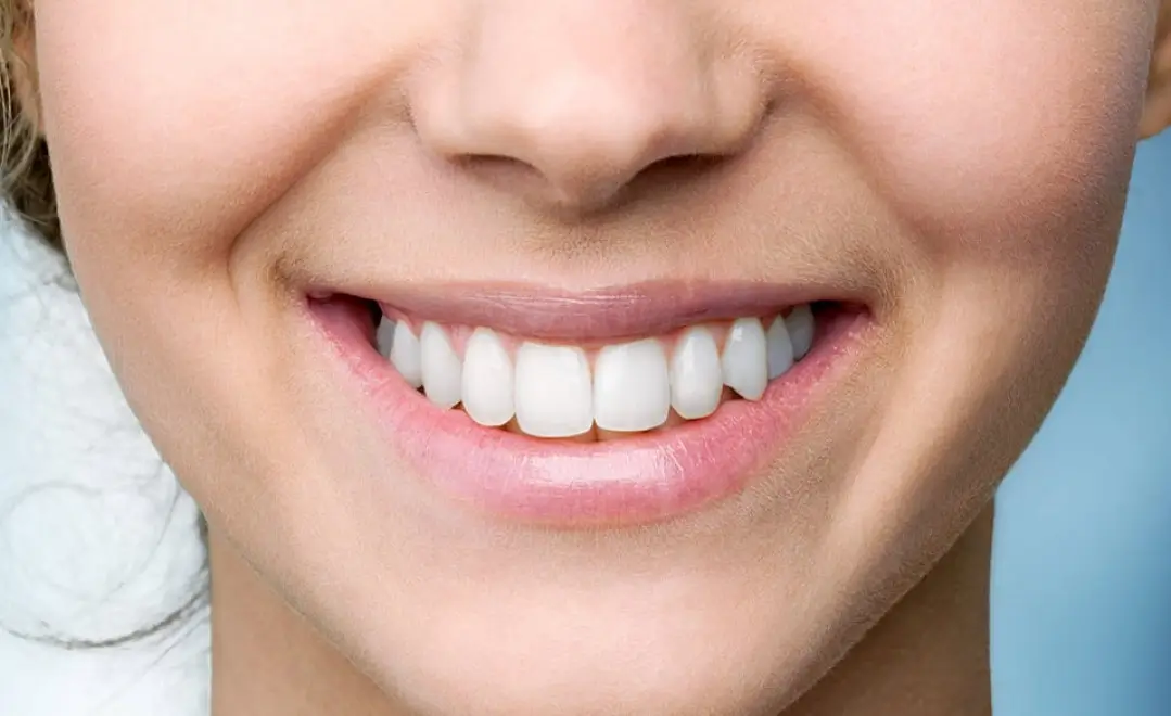 teeth-whitening-Glenferrie dental